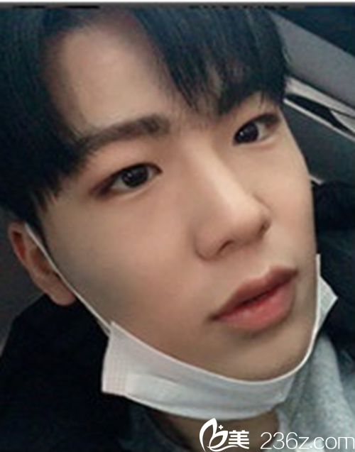 万般无奈下到韩国灰姑娘胆战心惊的做了鼻部+眼睛矫正，结果让其他人伤心了