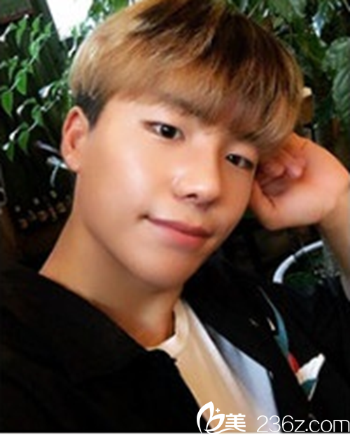 韩国新帝瑞娜医院鼻部整形术后 韩国新帝瑞娜医院鼻部整形术后