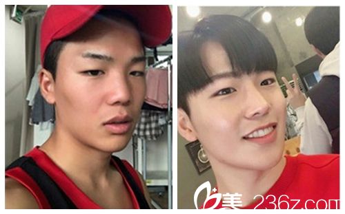 韩国新帝瑞娜医院鼻部+眼睛矫正术前术后对比图 韩国新帝瑞娜医院鼻部+眼睛矫正术前术后对比图