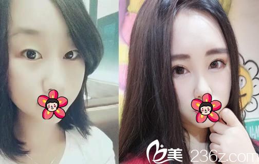 宁波北仑美仁洪江山双眼皮开眼角案例 宁波北仑美仁洪江山双眼皮开眼角案例