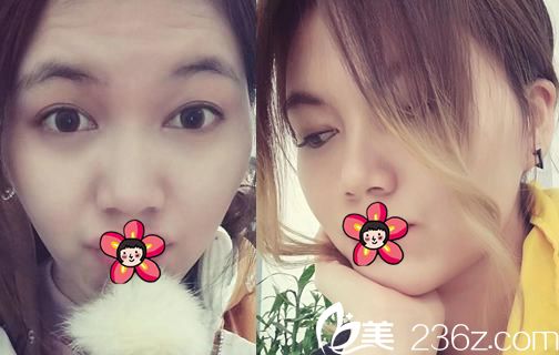 宁波美仁整形王英俊院长鼻综合案例 宁波美仁整形王英俊院长鼻综合案例