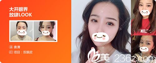 武汉美基元双眼皮真人案例 武汉美基元双眼皮真人案例