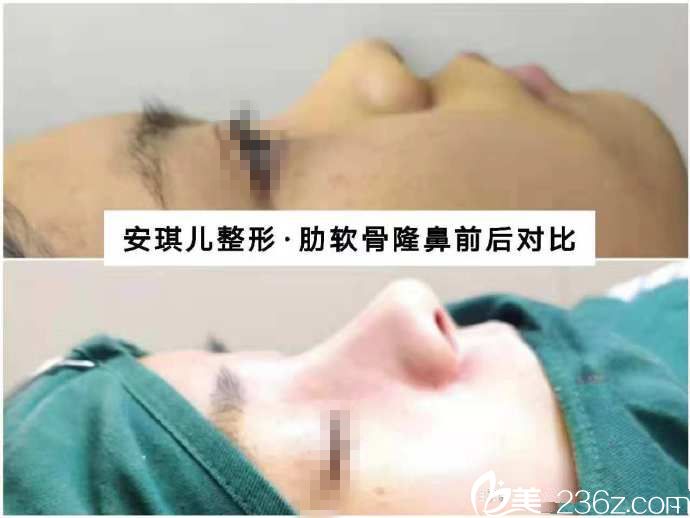 十堰安琪儿肋软骨即刻效果对比 十堰安琪儿肋软骨即刻效果对比