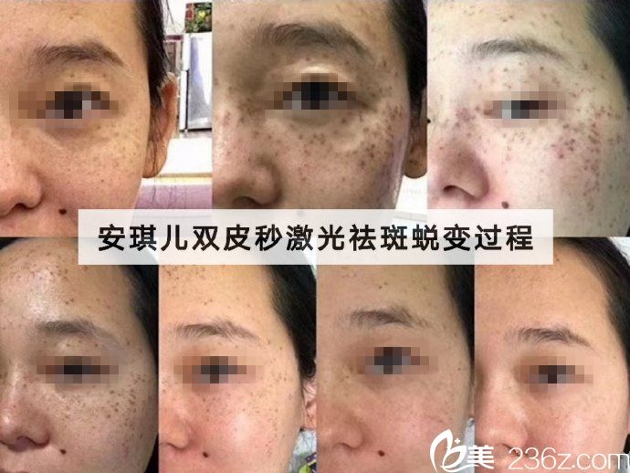 十堰安琪儿皮秒祛斑案例 十堰安琪儿皮秒祛斑案例