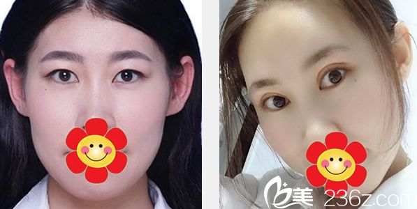 赵彦波医生全切眼皮+全脸脂肪填充前后效果对比