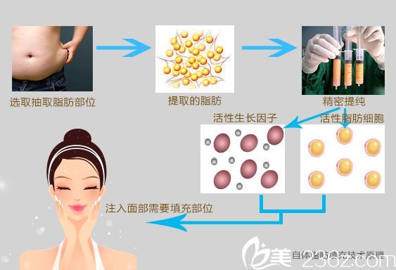 自体脂肪移植填充全过程