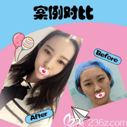 黄瑞兴自体脂肪填充全面术真人前后效果对比