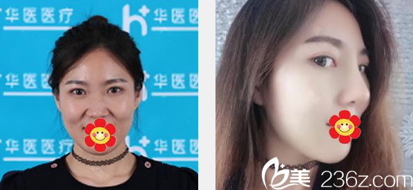 华医高青华割双眼皮隆鼻效果案例