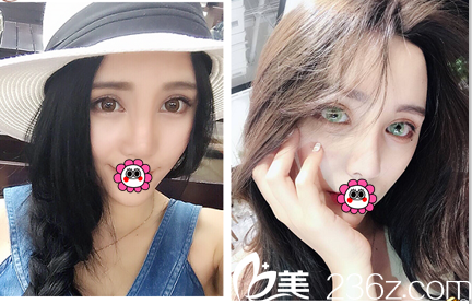 北京玲珑梵宫肋软骨隆鼻多少钱？自体肋软骨隆鼻特惠价格表和案例来了解