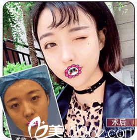 南京美贝尔黄名斗院长双眼皮前后对比照 南京美贝尔黄名斗院长双眼皮前后对比照