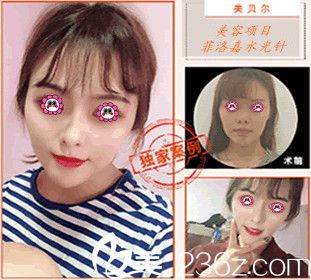 南京美贝尔整形医院案例 南京美贝尔整形医院案例
