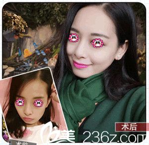 美贝尔整形医院自体脂肪面部填充变化图 美贝尔整形医院自体脂肪面部填充变化图
