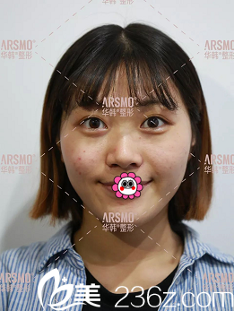 在北京华韩做自体脂肪面部填充前样子 在北京华韩做自体脂肪面部填充前样子