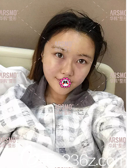 余恩旭医生给我做面部脂肪填充天样子 余恩旭医生给我做面部脂肪填充天样子