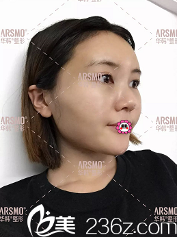 北京华韩余恩旭自体脂肪面部填充 北京华韩余恩旭自体脂肪面部填充