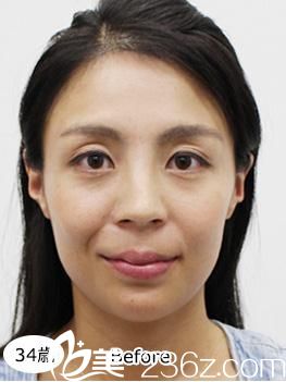 照屋智埋线提升前 照屋智埋线提升前