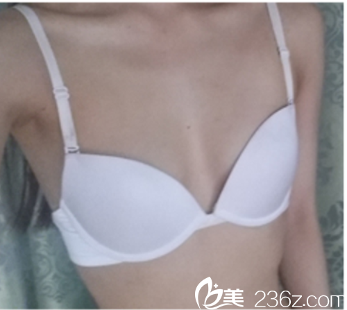 韩国麦恩医院假体隆胸术前 韩国麦恩医院假体隆胸术前