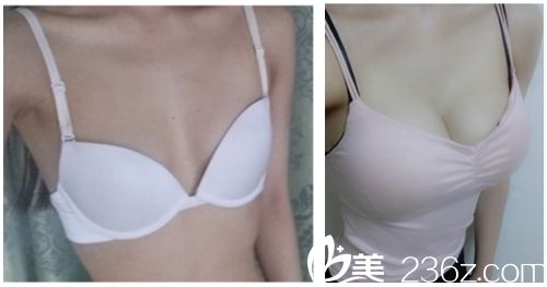 胸部整形术前术后对比图 胸部整形术前术后对比图