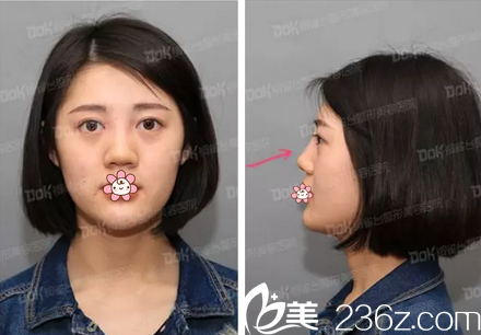 玻尿酸隆鼻术后正面侧面照片 玻尿酸隆鼻术后正面侧面照片