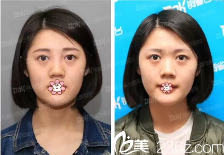 玻尿酸隆鼻与溶解后效果对比 玻尿酸隆鼻与溶解后效果对比