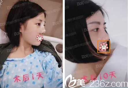 自体肋软骨隆鼻垫鼻尖术后照片 自体肋软骨隆鼻垫鼻尖术后照片