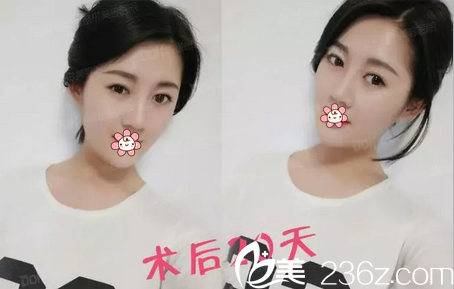 陶俊自体肋软骨隆鼻术后20天 陶俊自体肋软骨隆鼻术后20天