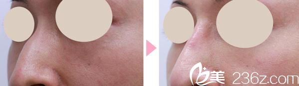 上田宽鼻骨削除手术前后对比