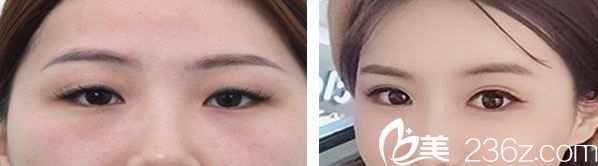 白圣佑医生做全切双眼皮效果案例 白圣佑医生做全切双眼皮效果案例