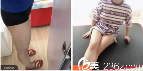 北京上上相大腿吸脂多少钱？郑楚蓉腿部环吸58000元起附案例