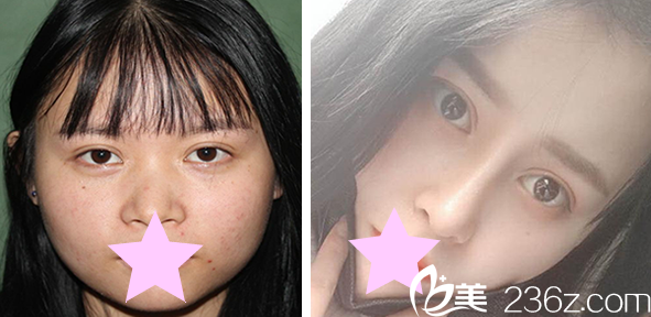 韩国本沐整形洪正秀医生做鼻综合+假体隆鼻效果案例 韩国本沐整形洪正秀医生做鼻综合+假体隆鼻效果案例