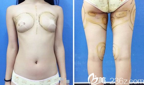 温州做自体脂肪隆胸多少钱?温州瑞亚原公立医院医生主刀脂肪丰胸价格2.8万起