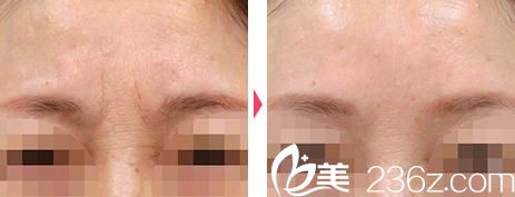 小池康弘瘦脸除皱祛皱前后对比