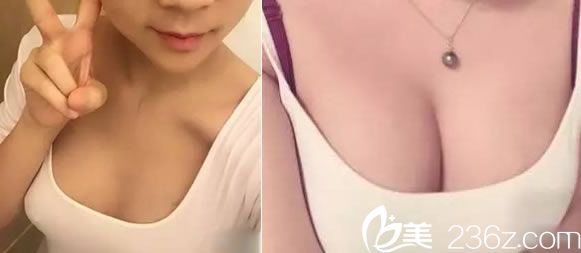 宁波建国整形马越波自体脂肪隆胸<span style= 宁波建国整形马越波自体脂肪隆胸<span style=
