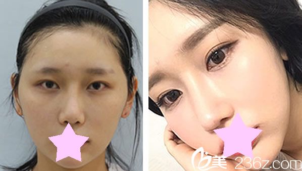 李芳硕医生鼻综合+耳软骨隆鼻效果案例 李芳硕医生鼻综合+耳软骨隆鼻效果案例