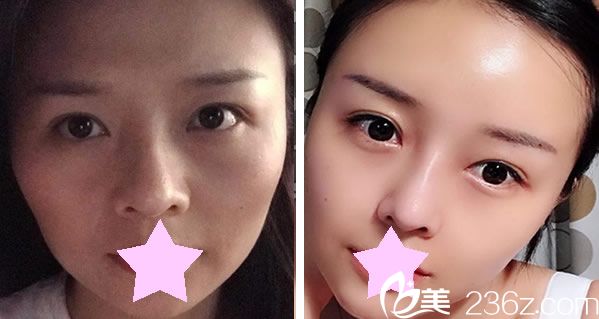 朴用南医生做全脸脂肪填充效果案例 朴用南医生做全脸脂肪填充效果案例