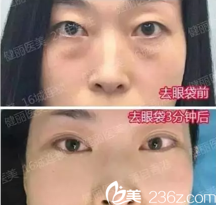 去眼袋手术多少钱？成都健丽医美去眼袋案例效果及整形价格表大放送
