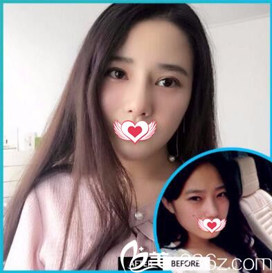 元生态双眼皮真人前后效果对比 元生态双眼皮真人前后效果对比