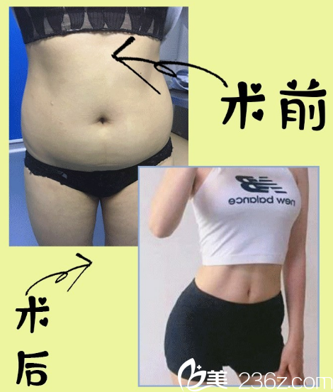 深圳仁安雅苗春来做吸脂多少钱？大腿腰腹吸脂4999元,宝丽太吸脂只要240元
