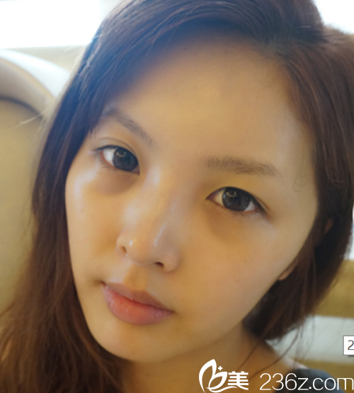 韩国麦恩医院眼部埋线+鼻部+脂肪填充术前 韩国麦恩医院眼部埋线+鼻部+脂肪填充术前