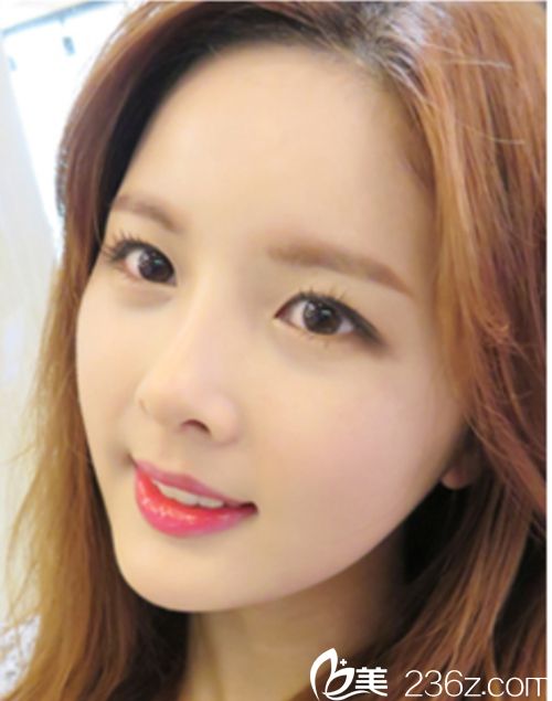 韩国麦恩医院眼部埋线+鼻部+脂肪填充术后1个月 韩国麦恩医院眼部埋线+鼻部+脂肪填充术后1个月