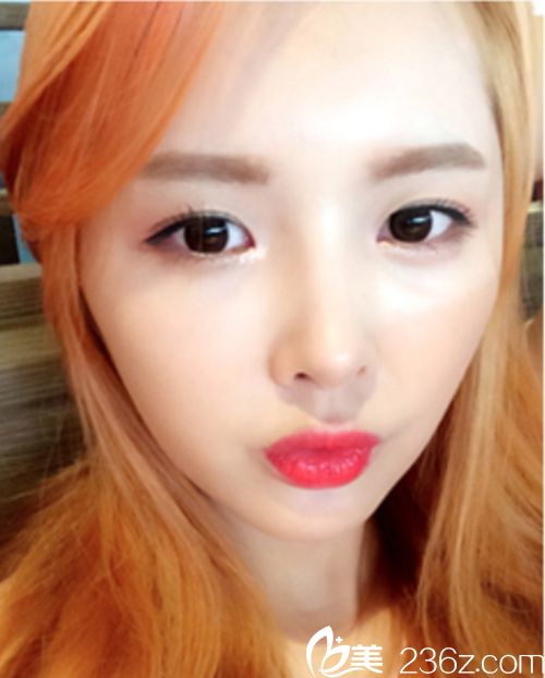 韩国麦恩医院眼部埋线+鼻部+脂肪填充术后3个月 韩国麦恩医院眼部埋线+鼻部+脂肪填充术后3个月