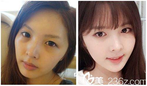 韩国麦恩医院眼部埋线+鼻部+脂肪填充术前术后对比图 韩国麦恩医院眼部埋线+鼻部+脂肪填充术前术后对比图