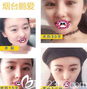 我在烟台鹏爱整形医院找魏璐做双眼皮对比图 我在烟台鹏爱整形医院找魏璐做双眼皮对比图