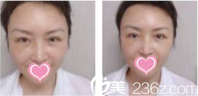上海双孖医疗美容门诊部张中航面部线雕真人案例术后第三天