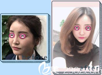 瘦脸对比图 瘦脸对比图