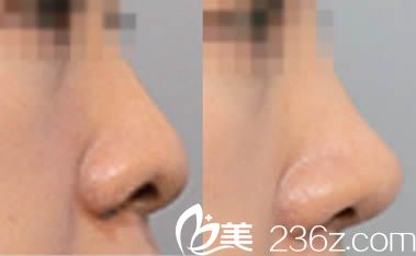 陈卫玲鼻部整形案例效果对比图