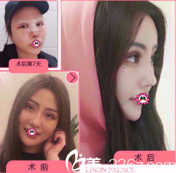 北京玲珑梵宫生态隆鼻多少钱？生态隆鼻4980元起王光辉黄海滨坐诊