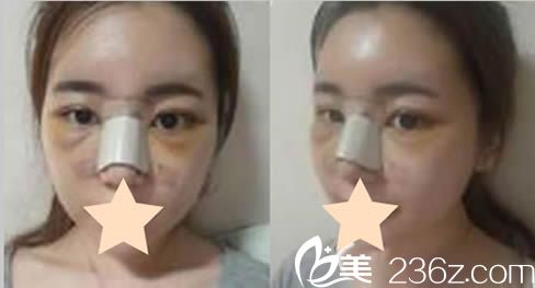 韩国然美之整形鼻综合和面部脂肪填充术后第3天照