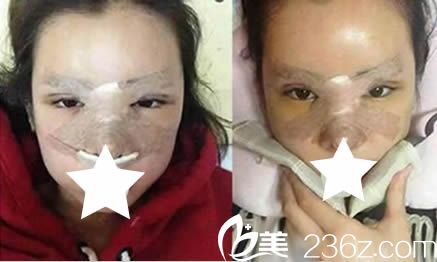 韩国青春整形双眼皮+鼻综合术后4天照 韩国青春整形双眼皮+鼻综合术后4天照