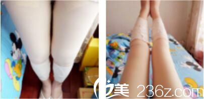 上海双孖医疗美容门诊部张国华抽脂瘦腿真人案例术后第五天